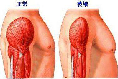 肌肉萎缩症的中医诊治疗法-第1张图片-中国中医健康网