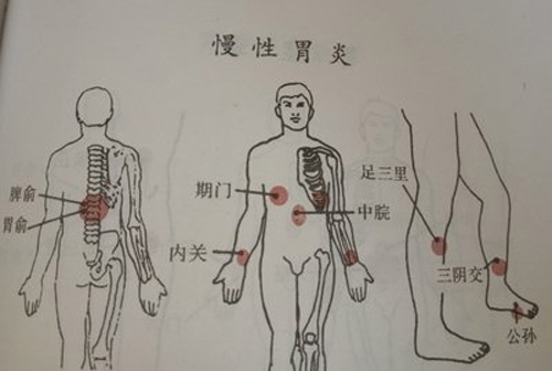 内关，足三里，中脘
