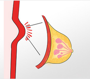 乳腺增生是什么病？-第1张图片-中国中医健康网