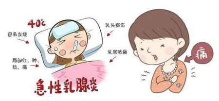 急性乳腺炎的推揉通络手法-第1张图片-中国中医健康网